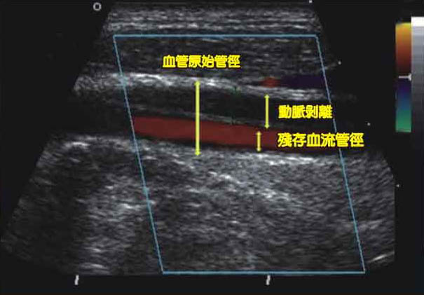 小心 頭痛可能是中風的先兆 談動脈剝離