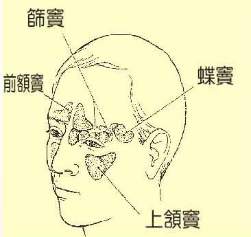 我的頭痛和鼻竇炎有關嗎 我的頭痛和鼻竇炎有關嗎