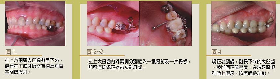 齒列矯正新方法 淺談 骨源性錨定裝置