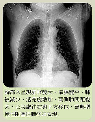 肺病