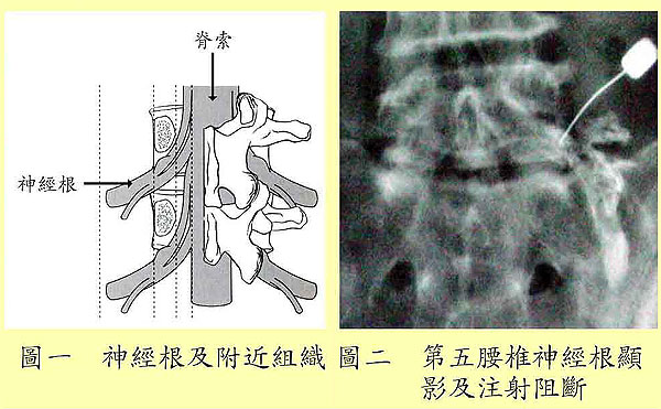 選擇性神經根阻斷法