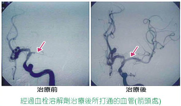 æ€¥æ€§è…¦ä¸­é¢¨ é»ƒé‡'æ™‚é–